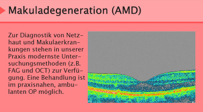 Makuladegeneration